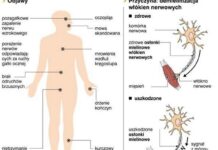 Chorzy na SM mogą liczyć na nowy lek