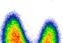 Radiojod w leczeniu tarczycy