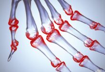 Jak zwyczajnie żyć z Reumatoidalnym Zapaleniem Stawów?