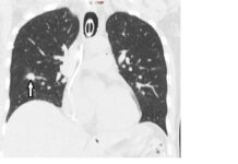 Pierwsza w Polsce termoablacja guza płuca