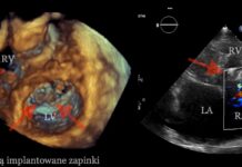 Pierwsza w Polsce pełna, przezskórna korekcja ciężkiej niedomykalności zastawki trójdzielnej metodą brzeg-do-brzegu