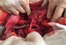 WUM: Unikalna na skalę światową operacja autotransplantacji nerki