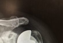 Endoprotezy stawu ramiennego: standard w Europie, w Polsce wciąż rzadkość