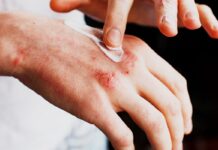 Pharmena: Badanie pilotażowe 1-MNA w łuszczycy wydłużyło się zaczerwieniona dłoń - smarowanie maścią