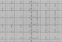 Medicalgorithmics wchodzi na rynek brytyjski zapis przykładowego EKG