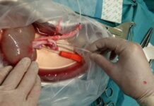 Nieodwracalna potrzeba DCD innowacyjny system nanogroup - płyn do przechowywania nerki przeznaczonej do transplantacji