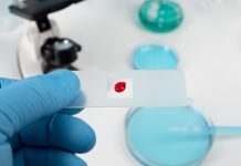 Hematoonkologia: więcej możliwości to więcej nadziei ręka w rękawiczce trzyma szkiełko mikroskopowe z kroplą krwi